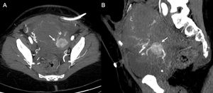 36-year-old woman who had a caesarean section and required re-operation within 24 h due to massive haemoperitoneum secondary to ruptured ovarian endometrioma. She was re-admitted with tympanic abdomen and severe pain. Suspecting active abdominal bleeding, CT angiography of the abdomen and pelvis identified a pseudoaneurysm of the left uterine artery (arrow) in the axial (A) and sagittal (B) maximum intensity projection reconstructions of the arterial phase. During admission, she suffered massive metrorrhagia, so it was decided to re-operate and a bleeding point was detected in the hysterography. However, in view of the situation of haemorrhagic shock during surgery, a subtotal hysterectomy was performed. A few hours later, the patient had significant metrorrhagia with clinical repercussions and the haemodynamic option was finally chosen, which successfully embolised the uterine arteries. After that, her progression was favourable.