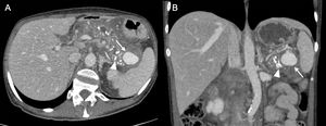 A 50-year-old man with a previous history of chronic pancreatitis had an episode of exacerbation. Axial (A) and coronal (B) CT angiography reconstructions of the abdomen and pelvis in the arterial phase show a pseudoaneurysm of the splenic artery (arrow) adjacent to the tail of the pancreas and close to the splenic hilum. The pancreas shows numerous calcifications (arrowhead) as a sign of chronic pancreatitis.