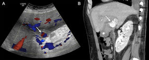 50-year-old man who came in with arterial hypotension, fever and pain in the right hypochondriac region. Blood tests showed increased acute phase reactants. With clinical suspicion of complicated biliary colic, ultrasound of the abdomen and pelvis (A) showed signs of acute calculous cholecystitis and, when colour Doppler was applied, a structure with the "yin-yang" sign was detected in the hepatic hilum (arrow). Sagittal maximum intensity projection reconstruction of the arterial phase CT angiography (B) confirms a pseudoaneurysm of the right hepatic artery (arrow). It progressed to haemorrhagic cholecystitis and urgent embolization of the pseudoaneurysm was performed.
