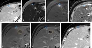 A 68-year-old woman with history of duodenal cancer (T2N0M0) treated surgically with cephalic duodenopancreatectomy, leaving her disease-free, attended the emergency department with fever and liver function abnormalities. (A) Axial slice of CT of the abdomen, identifying two new-onset hypodense liver lesions: one in segment VII (not shown) and another in segment IVa-b (arrowhead), with marked hypervascularisation in peripheral parenchyma. While these findings do not rule out metastases in the current clinical context, they could correspond to liver abscesses. (B) Axial slice from T2-weighted sequence of liver MRI showing the segment IVa-b lesion as mildly hyperintense, with even more hyperintense centre (arrowhead), adjacent to cyst (orange circle in B–F). Lesion appeared hypointense on T1 (not shown). (C, D) Axial slices from diffusion-weighted sequences of liver MRI showing no diffusion restriction in lesion (arrowheads). (E, F) Axial slices from dynamic liver MRI study, demonstrating ring-shaped arterial enhancement of lesion (E, arrowhead), which progressively increases in later phases (F, arrowhead). In the clinical context, and given absence of diffusion restriction, an abscess was considered the primary diagnosis, and antibiotic treatment was initiated. (G) Axial slice from early follow-up CT of the abdomen one month later, showing resolution of the lesions (arrowhead), confirming diagnosis of abscesses.