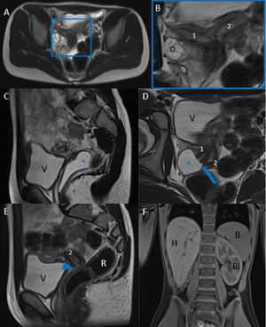 MRI of pelvis. (A) Axial T2-weighted sequences and (B) enlargement of (A) centred on region of interest. Uterus didelphys with right vaginal septum with prepubertal morphology. The uterine bodies (1 right/2 left) are in anteflexion, each turned to the side. (C) Sagittal oblique T2-weighted sequence and (D) Coronal oblique T2-weighted sequence centred on the cervix of the right uterus. Right cervix (1, arrow) with opening in the dilated right hemivagina and with hyperintense content (fluid) inside (*), corresponding to the cystic image described in previous ultrasounds. No apparent contact with the perineum. (E) Sagittal oblique T2-weighted sequence centred on left hemivagina. Left cervix (2) which continues into a collapsed elongated structure (arrowhead) that reaches the perineum, consistent with left hemivagina, which appears to be patent. (F) Contrast-enhanced T1-weighted VIBE sequence in parenchymal phase revealing solitary left kidney, compensatory growth. B: spleen, H: liver, O: right ovary, R: rectum, RI: left kidney, V: bladder.