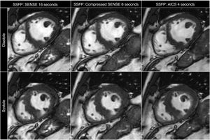 Comparison of short-axis cine SSFP images in diastole (top row) and systole (bottom row). Left column: SENSE (voxel size 8 × 1.8 × 1.8 mm), acquisition time per slice: 16 s. Centre column: Compressed SENSE (voxel size 8 × 1.8 × 1.8 mm), acquisition time per slice: 6 s. Right column: Compressed SENSE with AI (AICS - SmartSpeed), (voxel size 8 × 1.8 × 1.8 mm), acquisition time per slice: 4 s. Acceleration parameters optimised to achieve similar image quality with same signal-to-noise ratio. Despite accelerated acquisition of images with AI (right column), right ventricular endocardial trabeculae are better defined. Study performed using Philips Ingenia 1.5 T scanner (Philips Healthcare, Best, Netherlands) at Hospital Universitario Nuestra Señora del Rosario, Madrid, Spain. AICS: artificial intelligence compressed sensing; AI: artificial intelligence; SSFP: steady-state free precession.