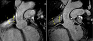 3D white-blood acquisition of thoracic aorta with ECG and respiratory gating. Left: compressed sensing. Estimated duration: two minutes. Right: compressed sensing combined with AI (AICS - SmartSpeed), same voxel size. Estimated duration: 50 seconds. The right image demonstrates superior quality with optimal visualisation of the coronary origin (yellow arrows: right coronary artery) due to improved patient tolerance to shorter acquisition time and reduced impact of respiratory irregularities. Study performed using Philips Ingenia 1.5 T scanner (Philips Healthcare, Best, Netherlands) at Hospital Universitario Nuestra Señora del Rosario, Madrid, Spain. AICS: artificial intelligence compressed sensing; ECG: electrocardiography; AI: artificial intelligence.
