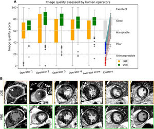 CNN-based virtual native enhancement (VNE) from T1 maps and cine sequences without intravenous (iv) gadolinium; compared to conventional late gadolinium enhancement (LGE). Application in patients with hypertrophic cardiomyopathy. Source: Zhang et al.40 Open access article through Commons Attribution License (CC BY) (https://creativecommons.org/licences/by/4.0/. CNN: Convolutional Neural Network; iv: intravenous.