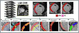 Method for extracting microstructure features in scar areas on late gadolinium enhancement (LGE) images using machine learning (ML) algorithm for arrhythmic risk stratification. Source: Zaidi et al.53 Open access article through Commons Attribution License (CC BY) (https://creativecommons.org/licences/by/4.0/). ML: machine learning.