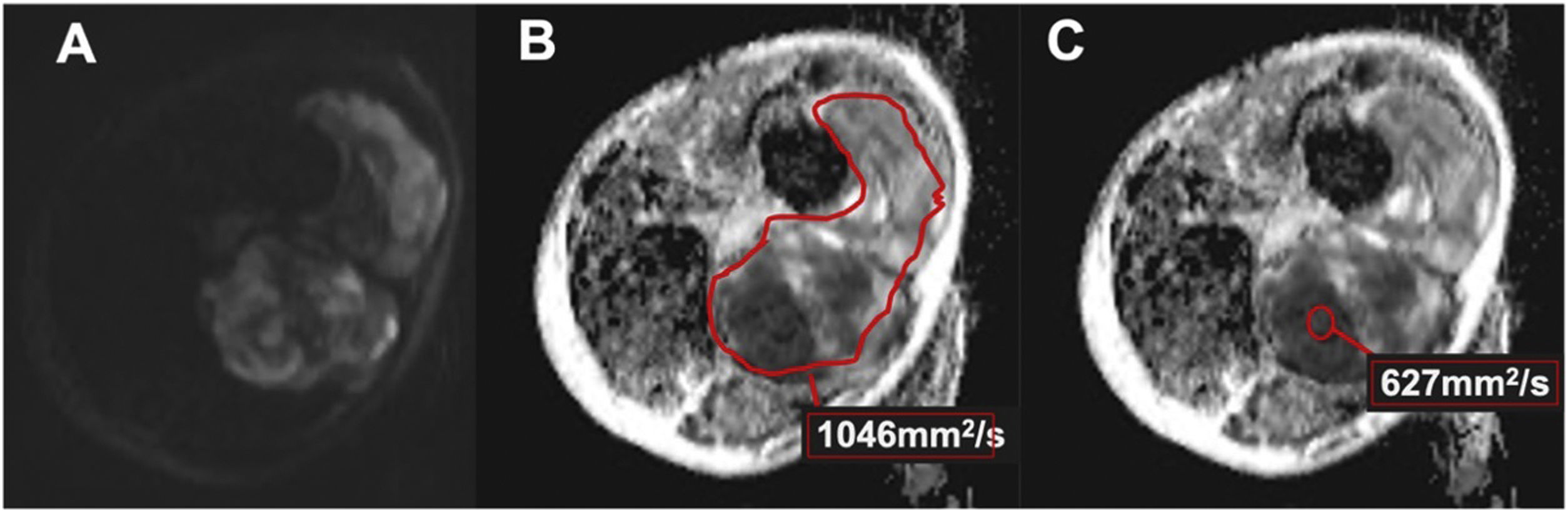 Role of diffusion-weighted MR imaging in the initial diagnosis of soft ...