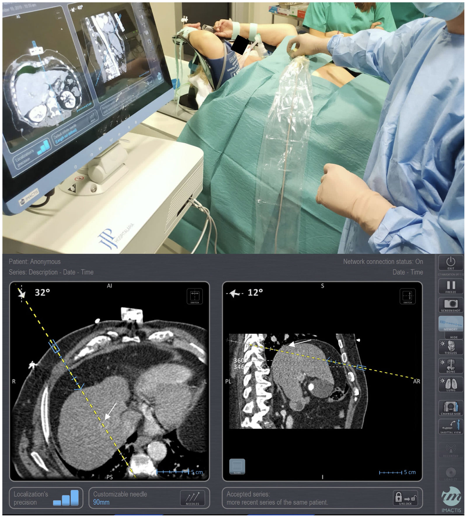 Percutaneous ablation of tumours in the hepatic dome assisted by CT ...