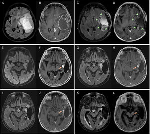 Glioblastoma in a 67-year-old woman in the left temporal-insular region. Follow-up assessment comparing FLAIR and T1-weighted post-contrast sequences from the diagnostic MRI (A, B), 48-h postoperative MRI (C, D) and post-radiotherapy MRI corresponding to the baseline MRI (E, F) to 1στ (G, H), 2νδ (I, J) and 3ρδ (K, L) follow-up MRI scans. Postoperative MRI 48 h later shows complete resection of the tumour-enhancing component (arrowheads). There is a measurable contrast-enhancing lesion in the baseline MRI (arrow) which, in the first repeat scan shows no changes (stable disease), in the second shows a reduction in size (partial response) and by the third, has disappeared (complete response). In subsequent follow-up checks, this last MRI will be the comparison MRI as it is the MRI with the best response. MRI: magnetic resonance imaging.