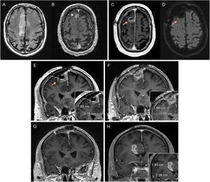 82-year-old man diagnosed with glioblastoma in the right superior frontal gyrus. Diagnostic MRI with FLAIR (A) and post-contrast T1 (B) sequences, showing a small anterior paramedian frontal focal enhancement (arrowhead). In the postoperative MRI (C–E) pericavity enhancement can be seen without alteration in diffusion (D), corresponding to residual tumour (arrows). A pre-radiotherapy MRI was performed, showing an increase in the size of the contrast-enhancement component, now measurable (F). In the post-radiotherapy MRI corresponding to the baseline MRI, the contrast-enhancement component (G) has disappeared. In the 1st follow-up MRI three months post-concomitant RT and CT (H), a new measurable lesion is evident, conclusive of disease progression. MRI: magnetic resonance imaging.