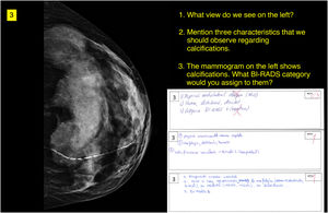 Example of question and answers. Corresponds to question 3, a craniocaudal mammography image with BI-RADS 2 benign vascular calcifications. The model, the first of the three answers shown, failed to identify the view, and was mistaken in the interpretation of the calcifications, which it assigned a BI-RADS 4, and earned 0.3 out of a maximum of 1 point. The other two responses shown, from students, obtained the maximum score of 1.