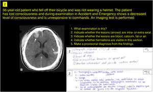 Example of question and answers. Question 2 presented a 36-year-old patient with head trauma and neurological impairment from a fall off a bicycle with no helmet. The model (first answer) obtained the maximum score by correctly answering everything requested. The second answer, from a student, incorrectly specified the type of indentation in the last of the five questions, earning 0.8 points for the sum of the other four correct answers.