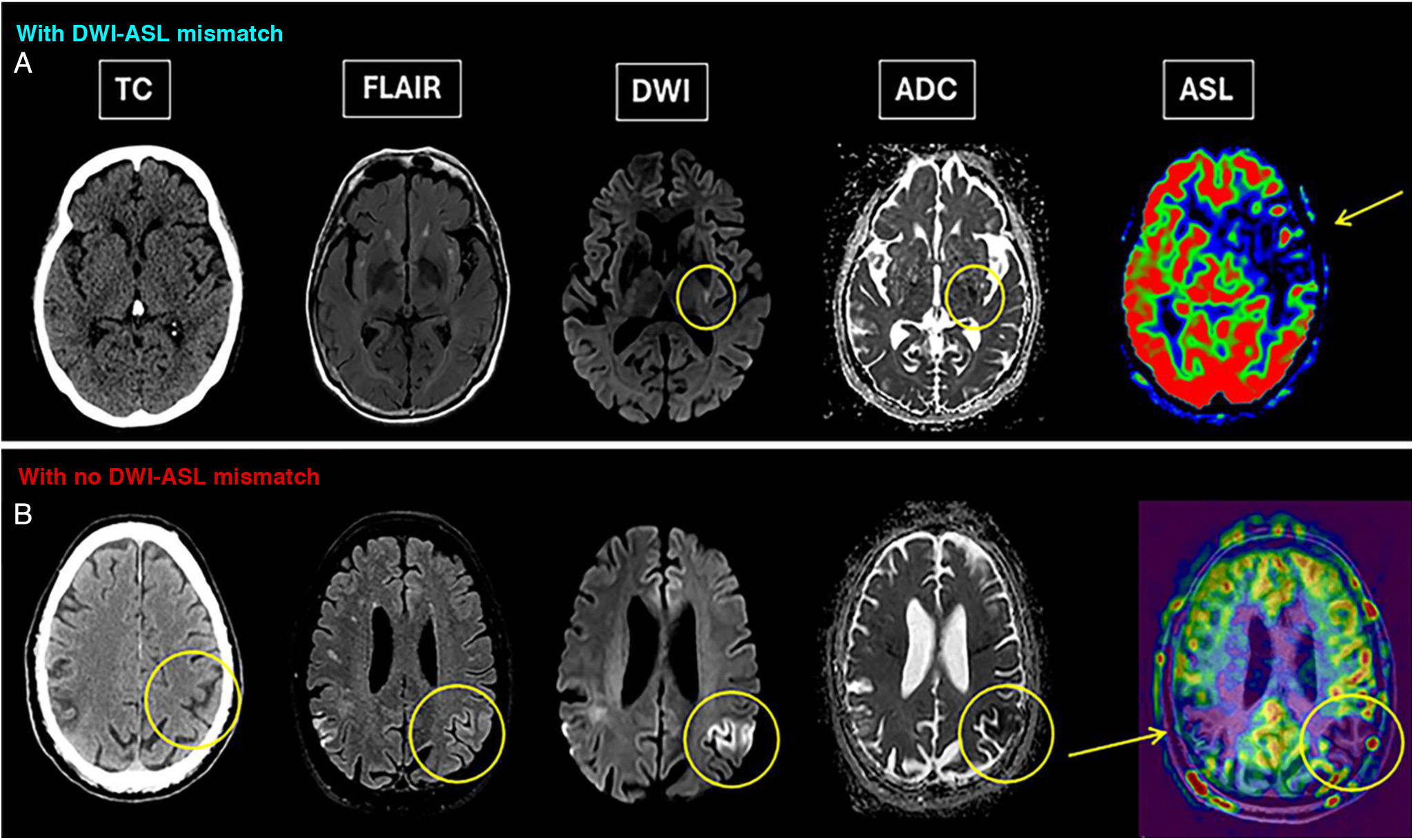 Normal Asl Mri Essential guide to arterial spin labelling: Review of key artifacts and ...