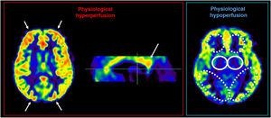 Left image shows physiological hyperperfusion pattern with greater flow in frontal and occipital cortices, as well as in posterior third of cingulate gyrus. Right image shows physiological hypoperfusion of globi pallidi (circles with solid line) and periventricular white matter (areas marked with a dashed line).