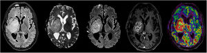 A 53-year-old male was examined due to a cerebral mass. MRI shows a heterogeneous intra-axial lesion with mass effect, surrounding oedema, diffusion restriction and enhancement on post-contrast T1-weighted imaging. The arterial spin labelling map reveals increased flow in the described lesion. All these findings are consistent with high-grade glioma.