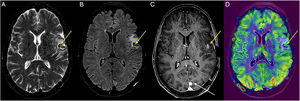 A 63-year-old male in follow-up for cerebral metastases from melanoma treated with radiotherapy. In the superior temporal gyrus, adjacent to frontal operculum, a small, well-defined lesion is seen. It is markedly hypointense on T2-weighted and FLAIR sequences (A and B), shows intense enhancement following contrast administration (C), hypoperfused on arterial spin labelling (ASL) (D) and associated with vasogenic oedema in the adjacent white matter (yellow arrows). ASL is key to determining that the lesion is secondary to radionecrosis and not tumour recurrence. Subsequent follow-ups show no changes to lesion in flow or size. Additionally, an extra axial lesion is observed in posterior portion of falx cerebri with intense and homogeneous enhancement consistent with a small left parafalcine meningioma (white arrow).
