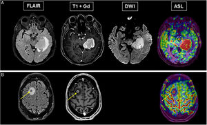 A) A 76-year-old female with no relevant history presenting with disorientation and speech abnormalities for two weeks. Magnetic resonance imaging (MRI) reveals lesion with marked enhancement, diffusion restriction and hyperperfusion on arterial spin labelling. It was a primary cerebral lymphoma. B) A 57-year-old male with history of melanoma was admitted due to epileptic seizures. MRI shows small, well-defined lesion in right superior frontal gyrus (arrow), with surrounding oedema, enhancement and focal increase in perfusion. Given the clinical context, it was attributed to metastasis.