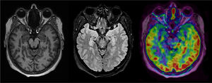 A 59-year-old female presenting with cognitive decline and memory failure. Although no significant parenchymal atrophy on morphological sequences, arterial spin labelling demonstrated asymmetrical pattern of hypoperfusion in anterior and medial regions of both temporal lobes, more pronounced on the right. Finding suggestive of Alzheimer’s disease.