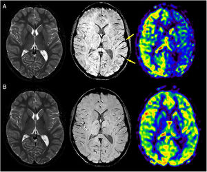 A 12-year-old boy attends hospital with acute onset headache and dysarthria. Upon admission, magnetic resonance imaging (MRI) is performed. A) T2-weighted images show no pathological signs. Susceptibility weighted imaging identifies venous thickening of the veins, particularly in the left hemisphere (arrows). Arterial spin labelling maps show clear asymmetry, with left hemispheric hypoperfusion. During admission, patient improves spontaneously. The patient’s father mentions having suffered similar episodes as a child. B) Follow-up MRI a month later confirms normalisation of perfusion map. Subsequent genetic study confirmed suspicion of familial hemiplegic migraine.