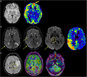 A) Eleven-year-old boy with episodes of focal impaired awareness seizures and with EEG revealing left frontal focal discharges. Cortical thickening is identified in the left frontal parasagittal region with subtle hyperintensity on FLAIR and small millimetric cystic-appearing foci (not shown in image). The described lesion does not exert mass effect, with no enhancement or diffusion restriction. The arterial spin labelling (ASL) map reveals increased flow within the described lesion, indicating activity in the epileptogenic focus (arrow). The lesion has all the radiological features of dysembryoplastic neuroepithelial tumour (DNET). B) A 76-year-old female under examination for right focal seizures which go on to be generalised. In addition to cortical thickening and FLAIR hyperintensity in the right parietal and temporo-occipital regions (arrows), there is subtle diffusion restriction in the right pulvinar nucleus (circle) and in the right temporo-occipital cortex (arrow). ASL map identifies areas of increased flow in the right parietal and temporo-occipital regions. Findings characteristic of patients in status epilepticus. C) A 65-year-old male patient with a left temporoinsular low-grade glioma in status epilepticus. FLAIR hyperintensity and focal increase in flow in the left pulvinar nucleus region (circle), as well as hypoperfusion of the contralateral cerebellar hemisphere (diaschisis phenomenon).