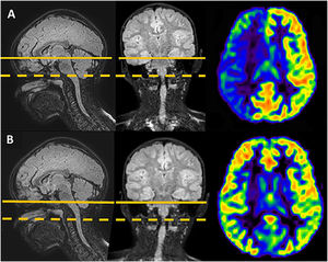 Six-year-old boy under investigation for generalised convulsive seizures. Solid lines show lower limits of acquisition planes. Dashed lines show labelling planes. A) The planes are initially placed too high in the study planning. Moreover, the patient’s head tilts to the right in coronal plane. This positioning error causes labelling failure, producing artifactual hypoperfusion in the right hemisphere in arterial spin labelling maps. B) After adjusting positioning of the planes, correct maps are obtained.