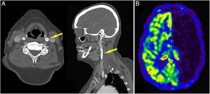 A 67-year-old female with right hemispheric clinical deficit. Computed tomography (CT) and CT angiography did not reveal any findings to explain symptoms. The patient had a left carotid artery stent (A). Magnetic resonance imaging with arterial spin labelling sequence was performed, which demonstrated artifactual hypoperfusion in the left hemisphere (B). Finding due to labelling failure, in this case caused by presence of stent.