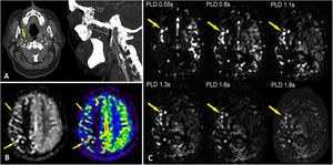 A) A 58-year-old male patient with significant stenosis of right internal carotid artery. B) Arterial spin labelling (ASL) maps in both grey-scale and colour. Asymmetric distribution of cerebral flow between both hemispheres is observed. In right hemisphere, cortical arterial branch pathway can be predicted due to the persistence of intra-arterial signal at this level (arrows). This phenomenon occurs due to prolonged transit time in right carotid territory caused by stenosis. ASL maps in grey scales make it easier to distinguish intra-arterial signal persistence artifacts. C) Sequence of images relating to previous patient shows dynamic ASL study, with successive post-labelling delay times. Dynamic ASL helps reveal asymmetry in blood flow, which is reduced in the left hemisphere. Persistence of intra-arterial signal (arrows) is observed, accompanied by delayed parenchymal filling in the right carotid territory (asterisks).