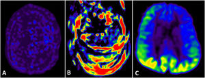 Various artifacts are presented: A) Artifactual reduction to overall flow signal due to inadvertent administration of paramagnetic contrast agent prior to image acquisition. B) Image degraded by patient motion artifacts, rendering it completely uninterpretable. C) Two-year-old child under examination due to epileptic seizures: an artifactual pattern of hyperperfusion in both occipital lobes is observed, due to eye opening during acquisition.