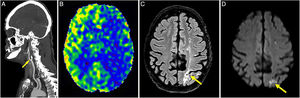A 68-year-old male with history of significant stenosis of internal carotid artery after cervical radiotherapy for head and neck cancer. Patient presents with episodes of left hemisphere neurological deficits. A) CT angiography of supra-aortic trunks reveals occlusion of left internal carotid artery from its origin at the carotid bulb, with associated calcified atheromatosis. B) ASL map reveals diffuse hypoperfusion in left hemisphere that explains patient’s symptoms. C) Hyperintense foci observed on FLAIR imaging in left parieto-occipital cortex and centrum semiovale, following a linear distribution along deep border zone, suggestive of ischaemic infarcts due to carotid hypoperfusion. D) Foci of diffusion restriction at parieto-occipital level, with smaller foci in left centrum semiovale and precentral sulcus, all consistent with acute ischaemic lesions.