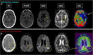 A) An 80-year-old male with two-hour history of right hemiparesis and aphasia. Computed tomography (CT) and magnetic resonance imaging (MRI) performed. Diffusion-weighted imaging (DWI) reveals single focus of restricted diffusion in posterior portion of lentiform nucleus (circle), consistent with acute infarction. ASL map shows drop in flow throughout middle cerebral artery territory (arrow). Extensive ischaemic penumbra, with mismatch between diffusion and ASL. B) A 74-year-old man with activated stroke code due to left hemispheric neurological deficit. Non-contrast scan shows loss of grey-white matter differentiation in left parietal convexity, consistent with acute ischaemic infarction (circle). No discrepancy is observed between area of acute infarction on DWI and area of hypoperfusion on arterial spin labelling (circles). No filling defects identified in time-to-flight sequence. Furthermore, patient presented with right temporoparietal lesion (partially included in these images and indicated with arrow). On CT, appears as subcortical hypodensity with cortical rim. On MRI, appears as cortical hyperintensity on FLAIR, with no diffusion restriction, normal apparent diffusion coefficient and reduced cerebral blood flow (arrow). Image consistent with subacute ischaemic infarction.