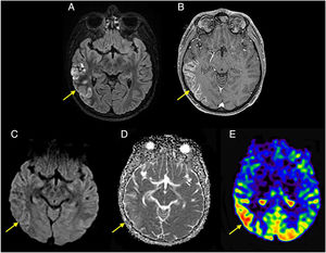A 23-year-old male in first month following bilateral lung transplant due to cystic fibrosis. Patient presents with tonic-clonic seizures and language abnormalities. A) FLAIR imaging shows cortico-juxtacortical hyperintense area in right temporal lobe; (B) with gyriform enhancement following contrast administration; (C, D) no diffusion restriction observed. Together, findings are consistent with subacute ischaemic infarction. E) Arterial spin labelling map reveals area of increased flow, presumed to represent luxury perfusion within infarcted region.