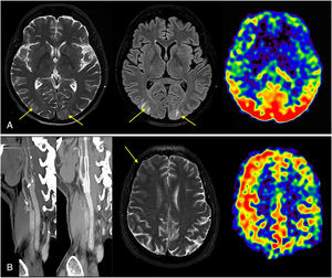 A) A 61-year-old woman, in third week following bilateral lung transplant. During admission, laboratory findings revealed thrombotic microangiopathy secondary to tacrolimus treatment, as well as reduced visual acuity. Both T2 and FLAIR images show hypersignal in subcortical white matter in both occipital lobes, consistent with vasogenic oedema (arrows). Arterial spin labelling (ASL) map shows bilateral increase in flow throughout occipital region, associated with PRES. B) A 62-year-old male who underwent angioplasty with stent in right internal carotid artery and restored flow. A week after the intervention, patient presents with generalised tonic-clonic seizures. On T2-weighted imaging, only finding observed is effacement of right frontal sulci. ASL map shows increase in cerebral blood flow values in right hemisphere. Hyperperfusion syndrome suggested as cause of seizures.