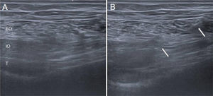 BT infiltration in the abdominal wall. (A) Musculature of the anterolateral abdominal wall, with the transverse muscle (T) difficult to visualise, located deep to the internal oblique (IO) and external oblique (EO), a characteristic finding in patients with abdominal wall weakness. (B) Infiltration process with a 22G needle, with the drug being deposited in the IO after the T has already been infiltrated; both appear thickened.