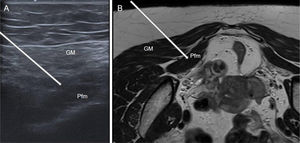 Theoretical course of BT infiltration in the piriformis muscle. (A) Ultrasound image, and (B) the corresponding MRI, with the course indicated by a white arrow. With the patient in the prone position, access would be from lateral to medial, traversing the gluteus maximus (GM) to reach the piriformis (Pfm).