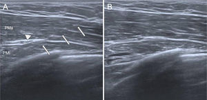 Ultrasound-guided infiltration of the pectoralis minor. (A) A 22G needle (white arrows) with its tip in the pectoralis minor (PMi), located deep to the pectoralis major (PMa), while avoiding the pectoral vascular branches (arrowhead). (B) Intramuscular distribution of the drug.