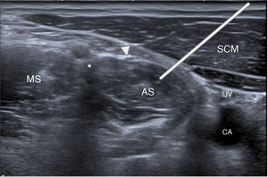 Anatomical plane for infiltration of the anterior scalene (AS), located deep to the sternocleidomastoid (SCM) and the phrenic nerve (arrowhead). The white line represents the theoretical course to be followed. The brachial plexus (asterisk) is visualised between the anterior and middle scalenes (MS), and medially the carotid space is identified, with the internal jugular vein (IJV) partially collapsed and the carotid artery (CA).