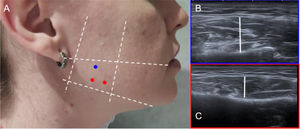 Example of anatomical landmarks for masseter infiltration. (A) Reference points for BT injection into the masseter, with the anatomical landmarks described in the body text, marked by white dotted lines. On the right, ultrasound anatomical sections corresponding to the most superior (B) and most inferior (C) level, where the masseter muscle is visualised (thickness indicated by a white line).