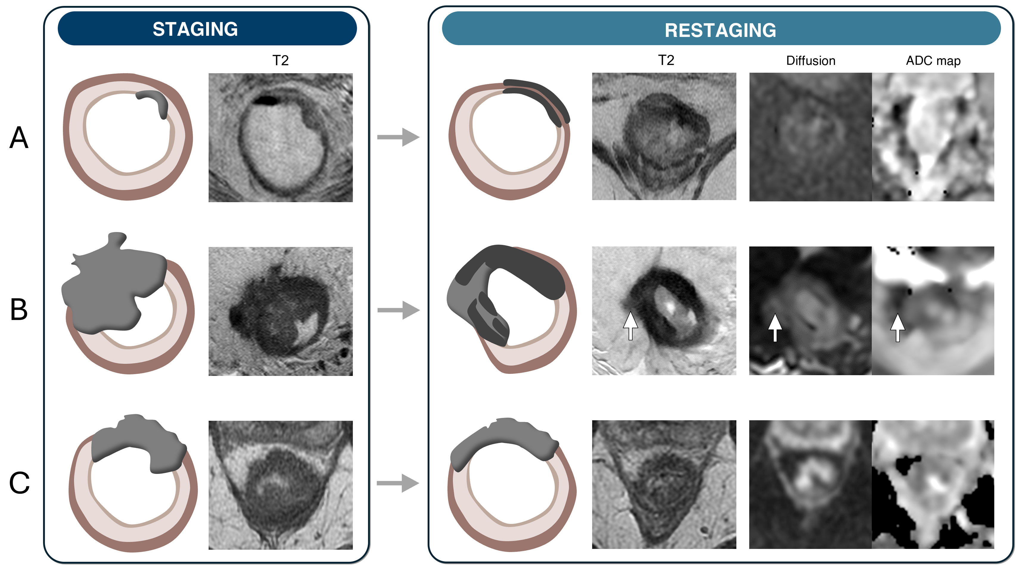 Role of magnetic resonance imaging in the evaluation of rectal cancer ...