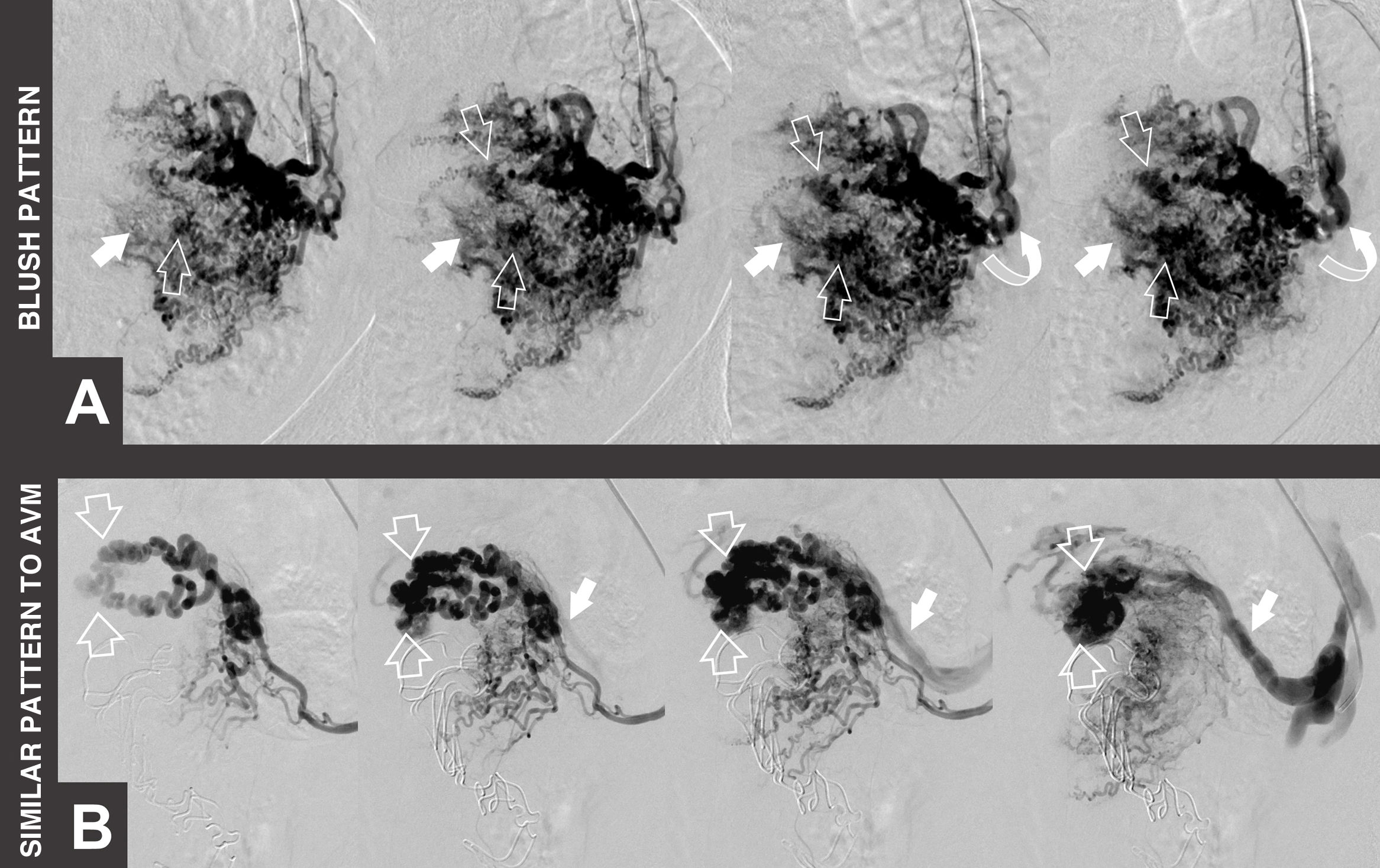 Endovascular management of hypervascular retained products of ...