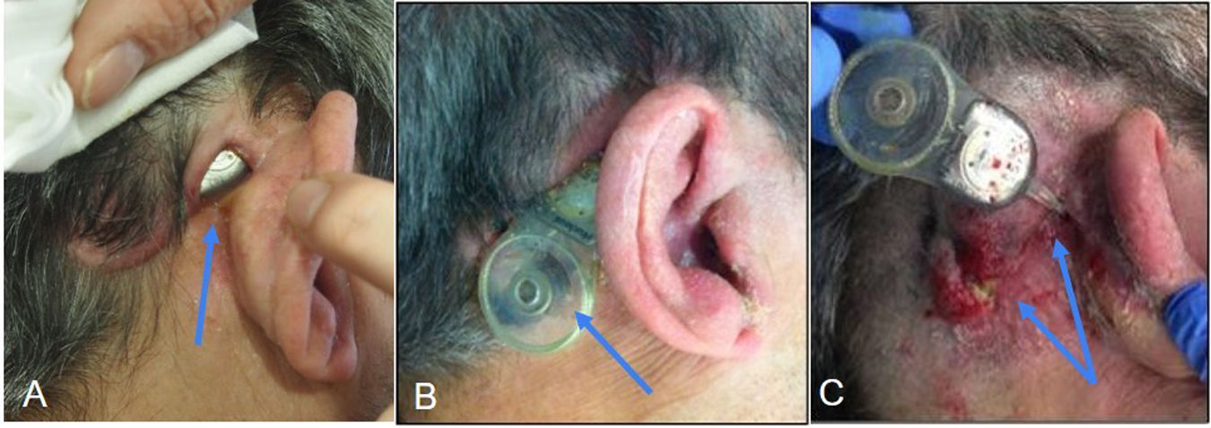Cochlear implant failures and complications: What should radiologists ...