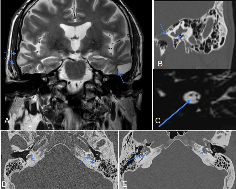 Cochlear implant failures and complications: What should radiologists ...