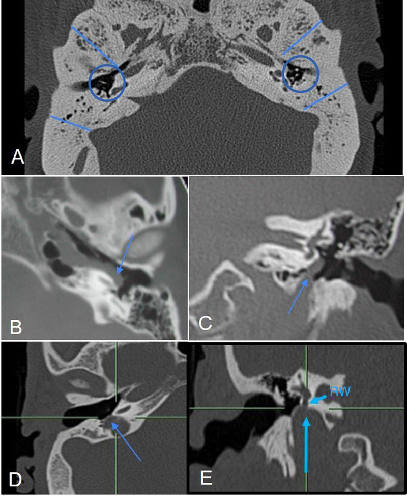 Cochlear implant failures and complications: What should radiologists ...
