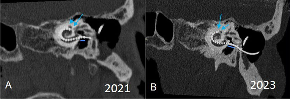 Cochlear implant failures and complications: What should radiologists ...