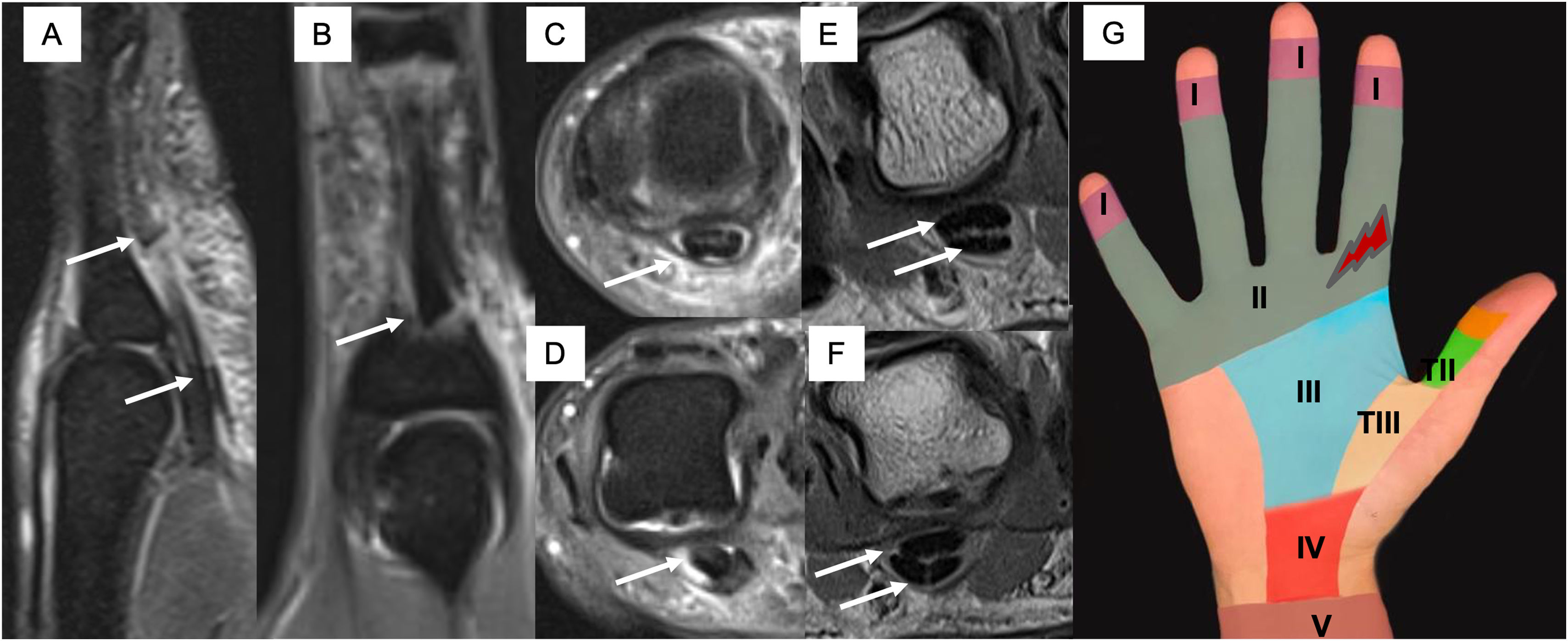 Fds Graphics Magnetic resonance imaging of the fingers: Anatomical assessment and ...
