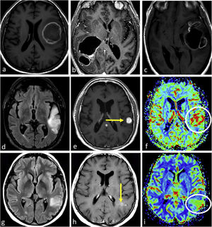 Three different typical presentations for IDH-wildtype glioblastoma in patients between 60- and 70 years old. In a–c, the most paradigmatic imaging features are seen in axial T1w-post contrast images of three different patients, with ring-enhancing irregular margins and extensive necrosis. In d–f: axial FLAIR, T1w-postcontrast, and CBV color maps from DSC-PWI. Extensive FLAIR left temporal infiltrative lesion (d) with associated solid nodular enhancement without necrosis (arrow in e) but with clearly elevated CBV (circle in f). In g–i: axial FLAIR, T1w-postcontrast, and CBV color maps from DSC-PWI. Focal FLAIR left temporal infiltrative lesion (g) with minimal enhancement and absent necrosis (arrow in h) but clearly elevated CBV (circle in i).