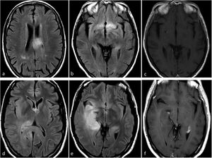 Possible Presentation of TERT or EGFR Altered Molecular IDH-wildtype glioblastoma. Two patients, 80-year-old (a-c) and 55-year-old (d–f). In axial FLAIR sequences (a–b and d–e), diffuse and extensive infiltrative hyperintensities reminiscent of a gliomatosis cerebri pattern in TERT promoter mutated glioblastomas. T1w post-contrast images (c and f) show no enhancement or signs of necrosis.
