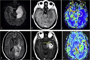 Two exemplifying cases in which biopsy results could render histological grade 2–3 results for an actual grade 4 tumor. A-c, 57-year-old patient. Axial FLAIR (a), T1w post-contrast (b) and DSC-PWI derived CBV color maps (c). Extensive FLAIR hyperintense medial left temporal infiltrative lesion (a), without enhancement or necrosis (b), and a subtle nodular focus of clearly elevated CBV (circle in c). i.e., a biopsy not capturing the high CBV foci would be at risk of undergrading this pathology proven IDH-wildtype astrocytic tumor as grade 2-3. (d–f), 58-year-old patient. Axial FLAIR (d), T1w post-contrast (e) and DSC-PWI derived CBV color maps (f). Extensive FLAIR hyperintense medial left temporal infiltrative lesion in (d), with a more focal area of prominent enhancement and necrosis (arrow in e) as well as high CBV (circle in f). i.e., a biopsy not capturing the necrosis and/or high CBV component would be at risk of undergrading this pathology proven IDH-wildtype astrocytic tumor as grade 2–3. Both patients were treated as IDH-wildtype glioblastomas under a tumor board's consensus decision.