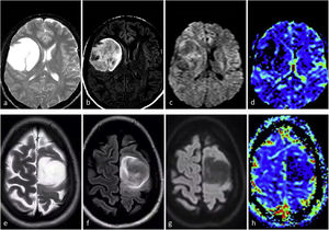 Two different patients with typical imaging features of IDH-mutant grade 2–3 astrocytoma. 31 (a–d) and 34 (e–h) years-old patients. Axial T2w (a and e), FLAIR (b and f), DWI (c and g), and DSC-PWI derived CBV color maps (d and h). Rounded, well-defined T2w hyperintense masses with corresponding FLAIR hypointensity, with a thin peripheral rim of hyperintensity: T2-FLAIR mismatch sign. Without significant diffusion restriction in DWI and low CBV in CBV color maps.