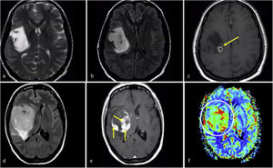 Imaging features in two patients with IDH-mutant astrocytoma grade 4. a–c, 37 years-old. Axial T2w, FLAIR, and T1w post-contrast. Extensive well-defined lesion hyperintense on T2w (a) with corresponding FLAIR hypointensity and thin peripheral hyperintense rim in (b), consistent with T2-FLAIR mismatch sign suggesting IDH-mutation. A small focus of enhancement and necrosis is seen within the deep margin of the tumor (c), suggesting grade 4. Also note that in this case, a biopsy not capturing the necrosis could undergrade the tumor as grade 2–3. Detection of grade 4 imaging features within a tumor with T2-FLAIR mismatch could be a specific presentation of IDH-mutant astrocytoma grade 4. d–f, 49 years-old. Axial FLAIR (d), T1w post-contrast (e), and DSC-PWI derived CBV color map (f). Well-defined, rounded tumor mass on FLAIR (d) with internal areas of solid enhancement (e) within non-enhancing tumor. Small foci of necrosis (arrows in e) and clearly elevated CBV (circle in f). Of note, more extensive necrosis existed in other parts of the tumor not captured in this figure. A grade 4 looking glioma in a patient under 55 with some atypical features for glioblastoma such as clear rounded morphology and well-defined margins could suggest an IDH-mutant astrocytoma grade 4.