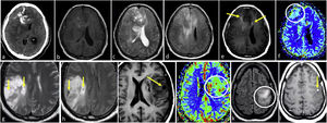 IDH-mutant 1p/19q-codeleted oligodendrogliomas grade 2–3. a–f, 53-year-old patient. Axial non-enhanced CT (a), T1w (b), T2w (c), FLAIR (d), T1w post-contrast (e), and CBV color map (f). Ill-defined diffuse bifrontal mass with extensive cortical infiltration (c and d) and heterogeneous signal on T1w and T2w (b and c). Prominent calcifications on CT (a). Very subtle irregular enhancement (arrows in e) and areas of elevated CBV (circle in f). (g and h) 52-year-old patient. Axial T2w (g) and FLAIR (h). Ill-defined infiltrative parietal mass with heterogeneous signal and extensive cortical infiltration (g–h). Presence of small characteristic intratumoral non-enhancing fluid signal intensity-like areas consistent with cystic foci (arrows in g and h). (I and j), 38-year-old patient. Axial T1w (i) and CBV color map (j). An example of a small intratumoral cyst on T1w (arrow in i) and clearly elevated CBV (j). K-l, 35-year-old patient. Axial FLAIR (k) and T1w post-contrast (l). Infiltrative ill-defined FLAIR hyperintense mass clearly centered on the cortex and following its gyriform morphology: continuous cortex sign (circle in k). Associated small foci of solid enhancement (arrow in l). Also note absent T2-FLAIR mismatch sign in c-d and g-h.