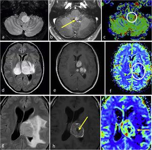 Diffuse mid-line gliomas H3K27-altered. a–c, 52-year-old patient. Axial FLAIR (a), T1w post-contrast (b), and CBV color map (c). Brain-stem glioma, slightly paramedian, nodular, and well-defined in FLAIR (a), with foci of enhancement (arrow in b) and slightly elevated CBV (circle in c). d–f, 48-year-old patient. Axial FLAIR (d), T1w post-contrast (e), and CBV color map (f). Bithalamic FLAIR hyperintense infiltrative mass (d) with multifocal solid nodular enhancements (e) and high CBV. G-i, 33-year-old patient. Axial FLAIR (g), T1w post-contrast (h), and CBV color map (i). Thalamic FLAIR hyperintense mass with extensive edema (g), irregular thick ring enhancement with central necrosis (arrow in h) and elevated CBV in the enhancing ring (arrow in i).